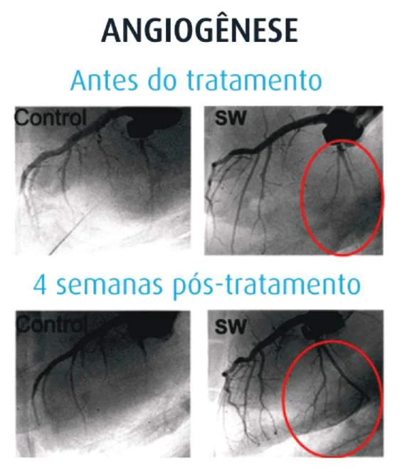 Angiogênese antes e 4 semanas após o tratamento com ondas de choque